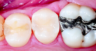 Class II DO on Second Bicuspid. Case Study