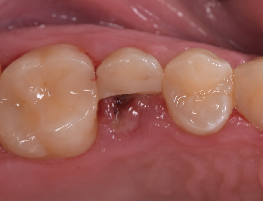 Fig. 1_Frattura coronale verticale di 2.5.