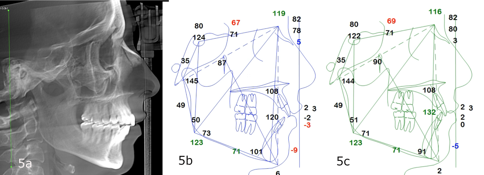 Figs. 5a–c: (a) Cephalometric radiograph. (b) Cephalometric tracing. (c) Visual treatment objective.