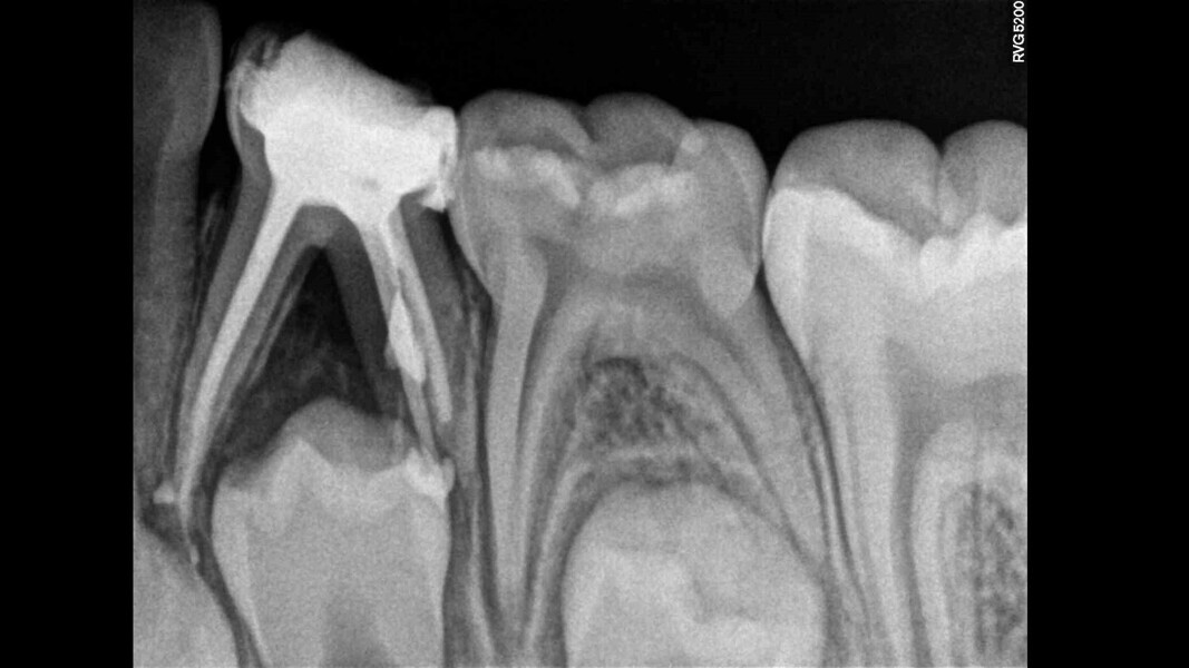 Fig. 7: Obturation and temporary restoration.