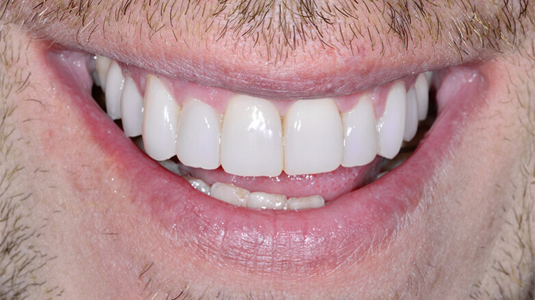 The next generation of  the composite veneering system