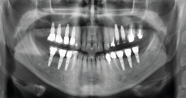 Cas clinique de chirurgie guidée : Extraction, implantation et mise en esthétique immédiate