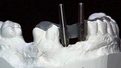 An in-office-fabricated implant surgical guide corrected using CBCT