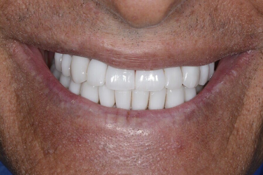 Figs. 26a–d: Ceramic veneers in the anterior maxillary and mandibular areas and temporary restorations in the mandibular posterior area.