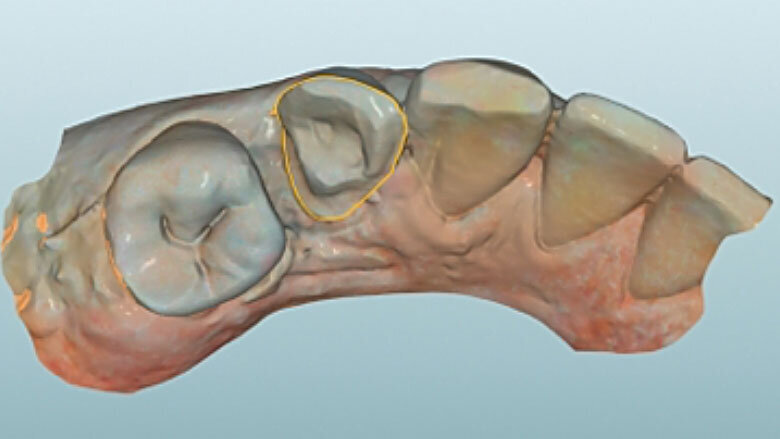 Fig. 5. Tras el escaneo intraoral se estableció el límite de la preparación.