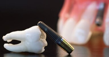 Studija otkriva nerealna očekivanja javnosti u vezi s dentalnim implantatima