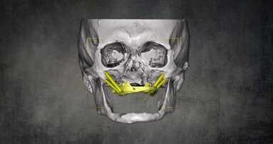 Precise implantation using zygomatic implants with Le Fort I osteotomy