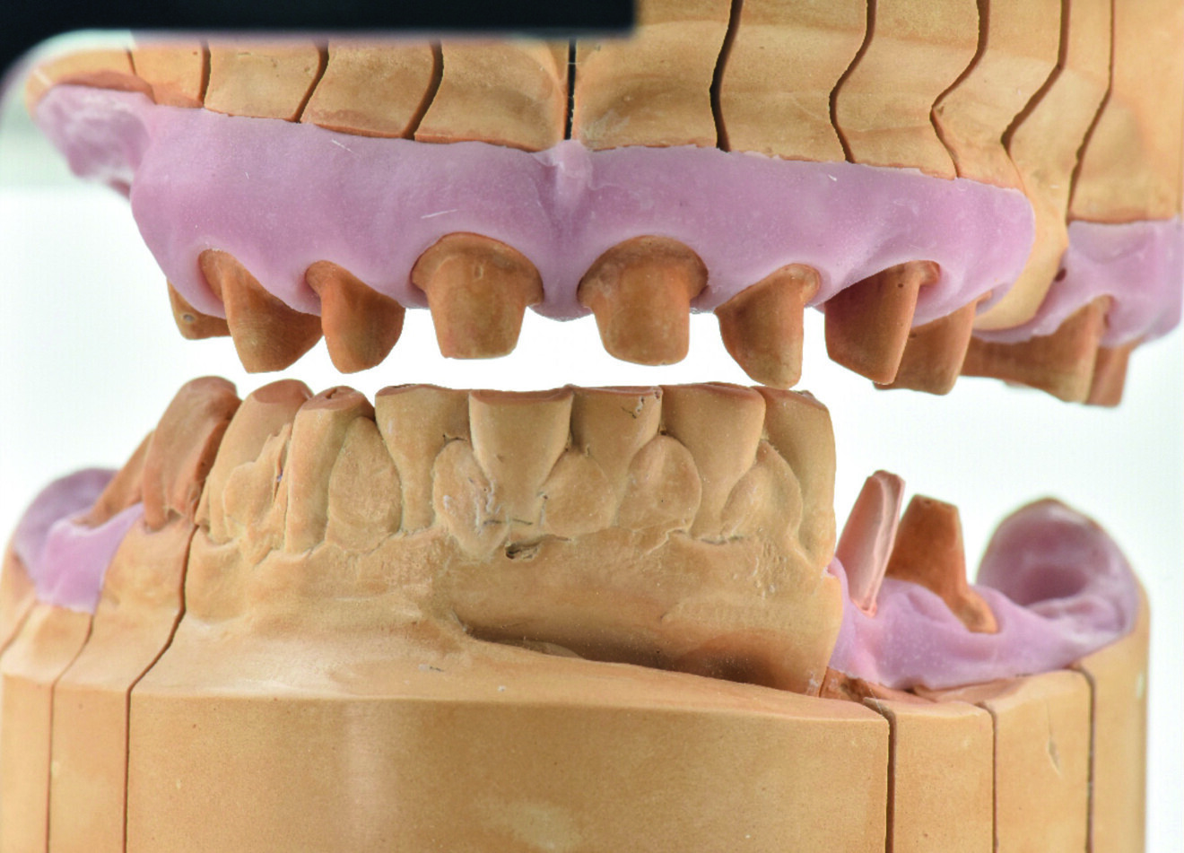 Fig. 2a : Situation initiale avec péri-implantite à un stade avancé.