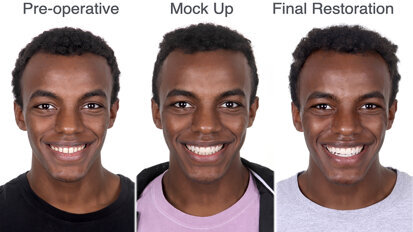 Veneer restoration: Calibrated preparation to close diastemas