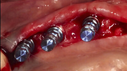 Efecto de la vitamina D en la osteointegración de los implantes dentales
