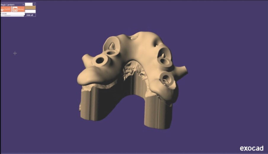 Figg. 21-25_Progettazione Cad con exocad.