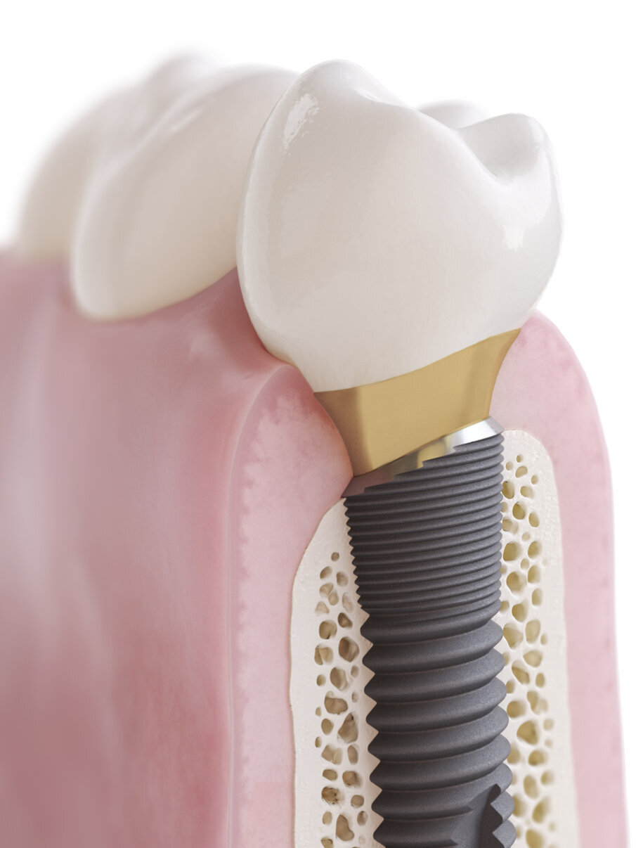 1228014-OsseoSpeed Profile EV premolar -D