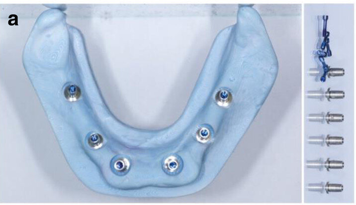 Fig. 7a: CAD/CAM model with the prefabricated titanium abutments (a), CAD/CAM cobalt–chromium framework (b) and composite veneered provisional FDP (c & d) before bonding to the abutments.