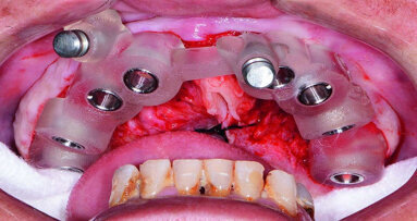Incorporating CAD/CAM solutions for full-mouth dental implant reconstructions