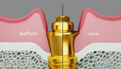 Nobel Biocare