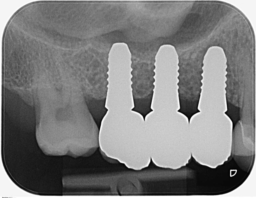 Fig. 25 : Radiographie de contrôle après l’insertion de la prothèse définitive. Il y a lieu de remarquer le défaut intra-osseux régénéré du côté mésial de la dent 18.