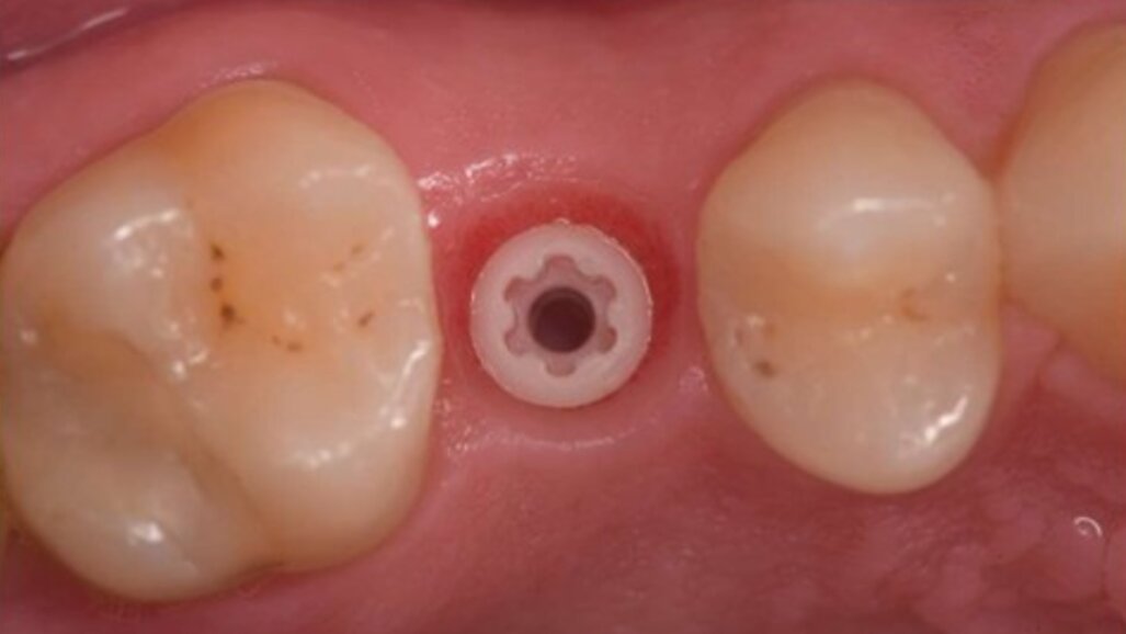 Impianti in Zirconia: una diversa risposta biologica al biofilm batterico