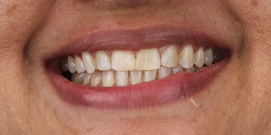 Fig 11. Final Smile