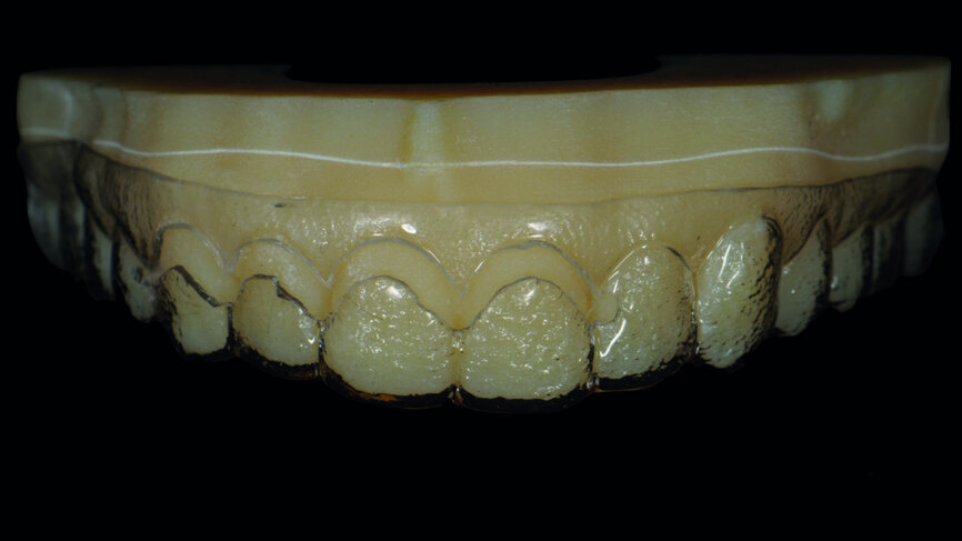 Fig. 5: Three-dimensionally printed model of the digital smile design planning, bearing a mock-up shell. A cervical opening was introduced for surgical access and guidance for crown lengthening.