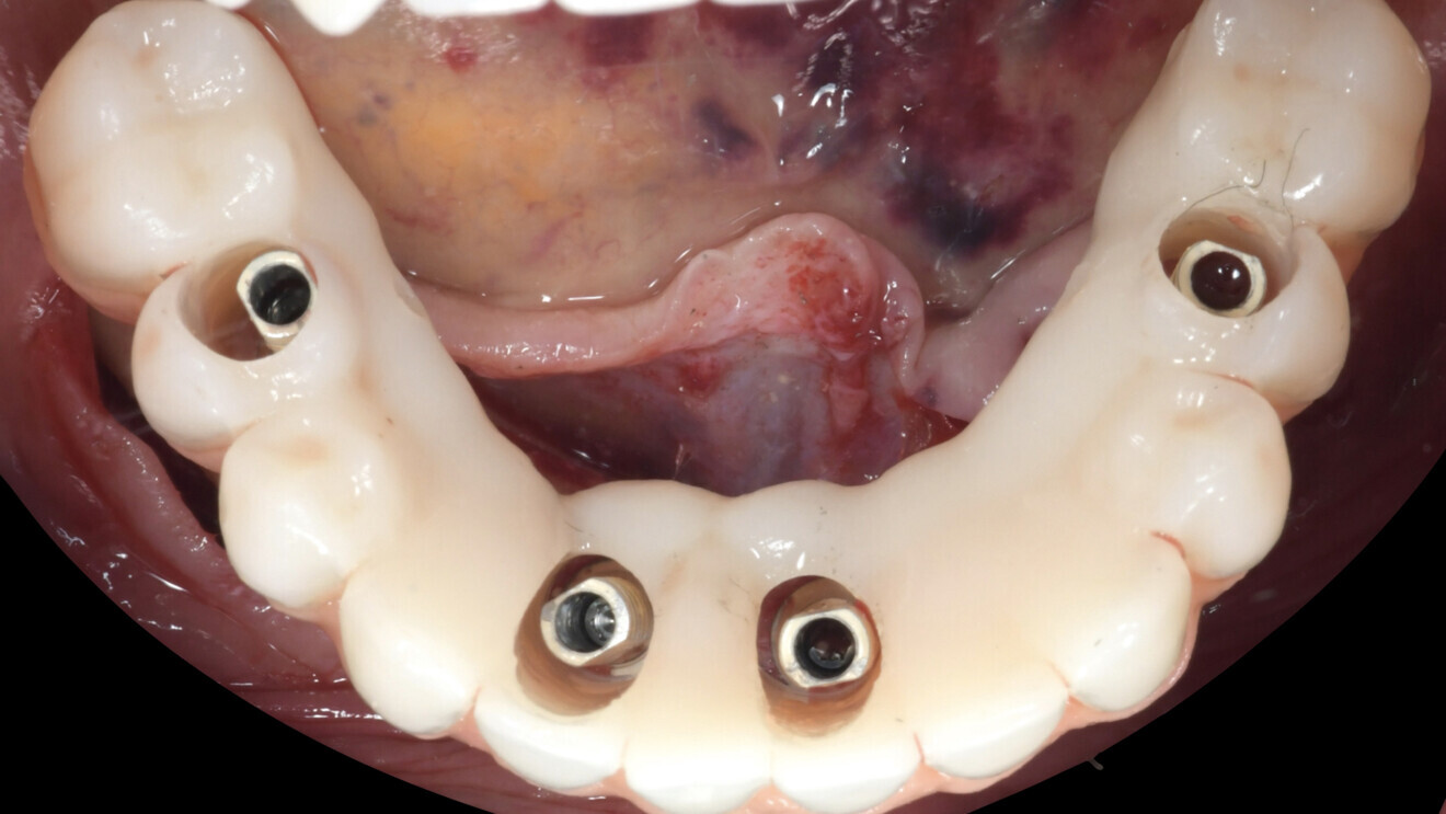 Fig. 12: The provisional prosthesis placed on the temporary abutments.