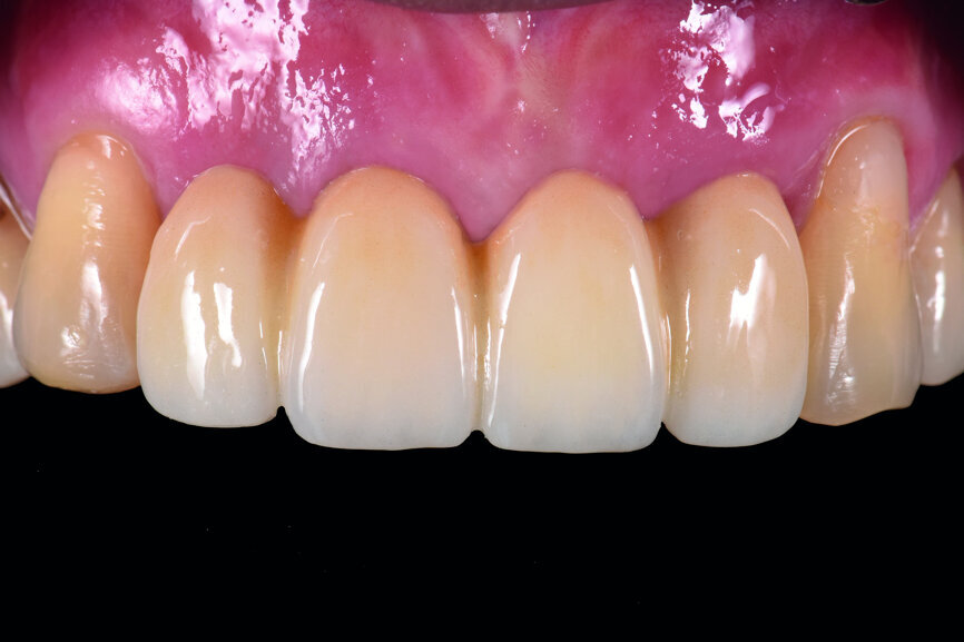 Fig. 48: Frontal view of the anterior teeth after two weeks. 
