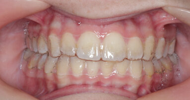 Boosting facial aesthetics through a hybrid approach of the Carriere Motion appliance and Reveal clear aligners