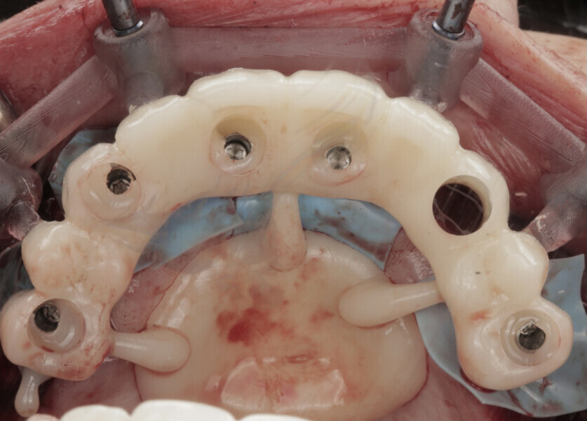 Fig. 14: Pickup of the provisional prosthesis.