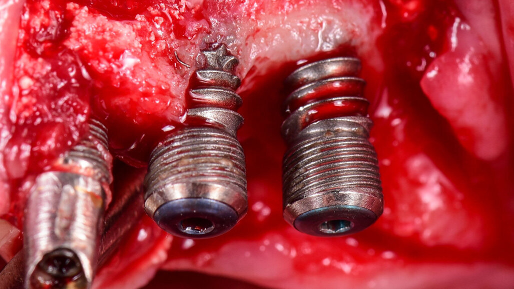 Swiss medical device manufacturer GalvoSurge Dental acquired by Straumann