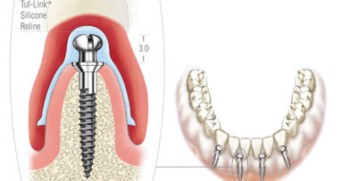 The Atlas Denture Comfort System