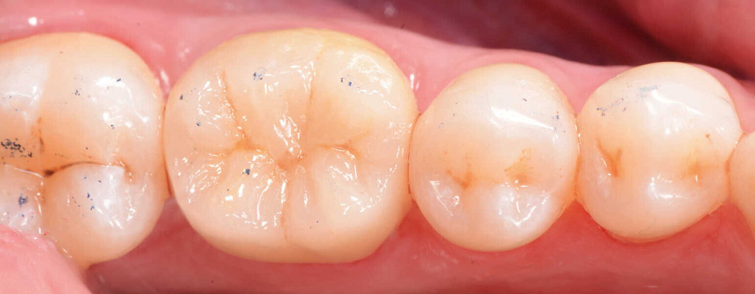Figs. 12a y 12b. Vista final lateral y oclusal.