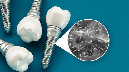 Dentistry at nanoscale: how nanotechnology advances the properties of dental implant surfaces