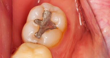 Three African countries to phase down dental amalgam use
