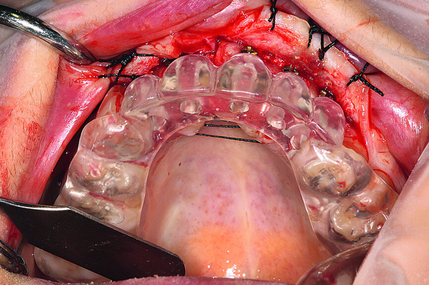 Fig. 14: Testing of the sterilised
surgical drilling guide proved drilling would be at the centre of the reconstructed bone ridge.