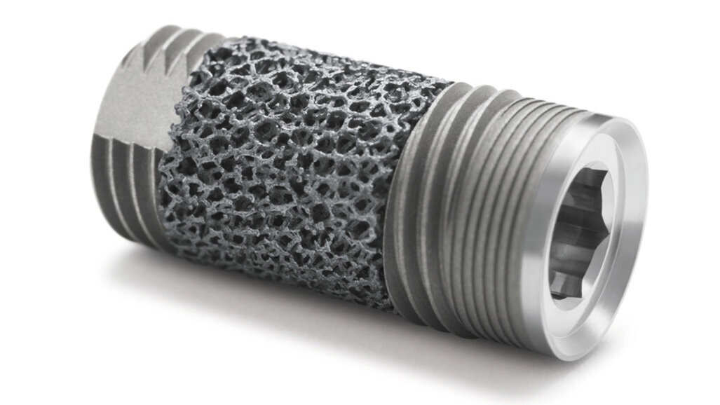 Clinical evidence reveals unique biological response to Trabecular Metal dental implant