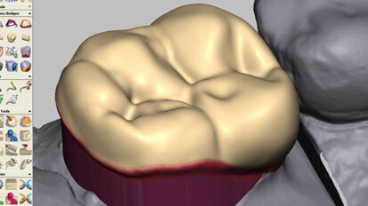 Designing multiple restoration types using one dental CAD/CAM system
