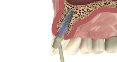 MIS releases new EZ-Base abutment