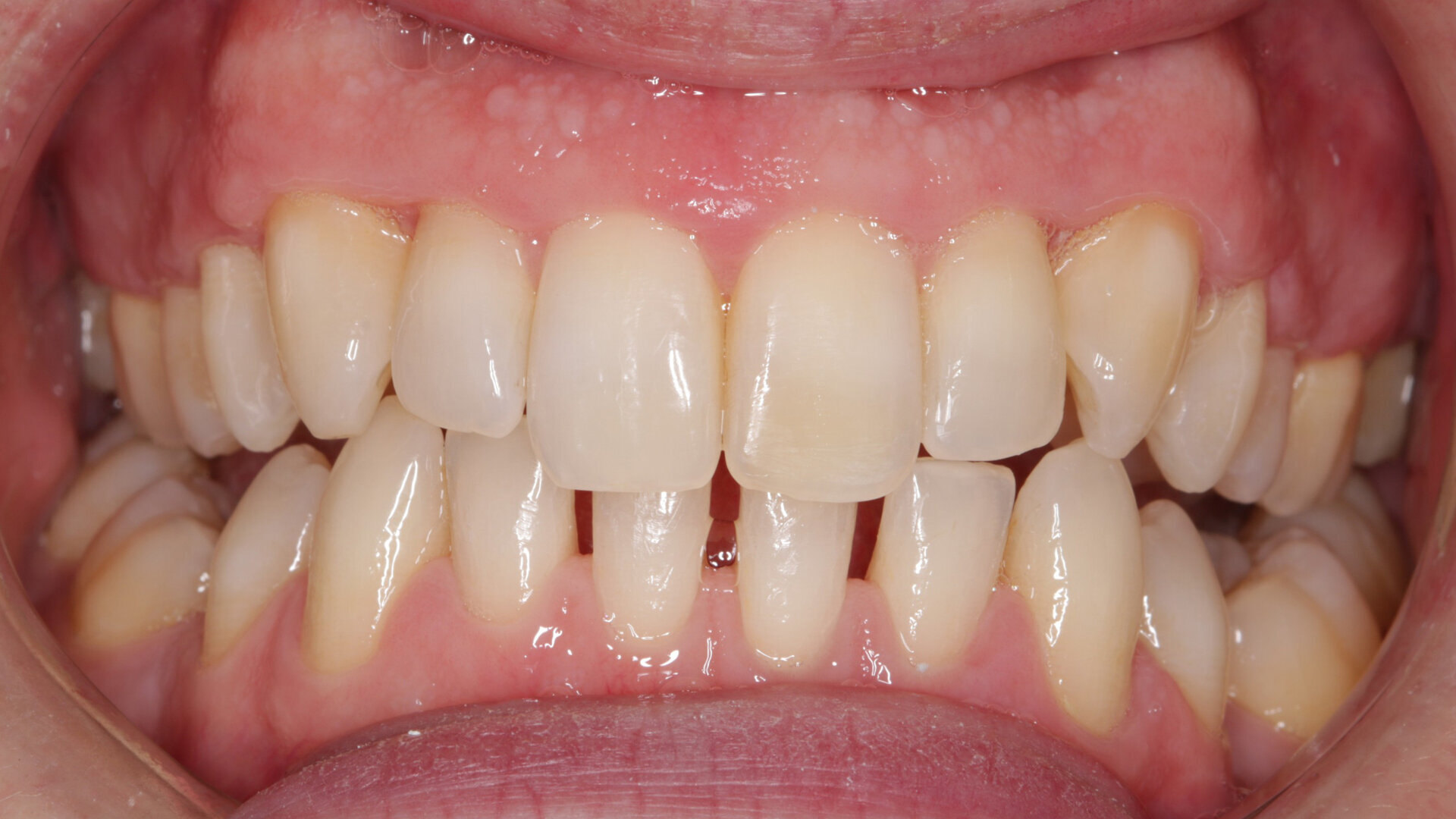 Getting to grips with general dental practitioner orthodontics