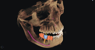 CEREC meets GALILEOS: Implant planning reaches a new level
