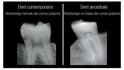 Selon une nouvelle étude, les radiographies dentaires peuvent révéler une carence en vitamine D