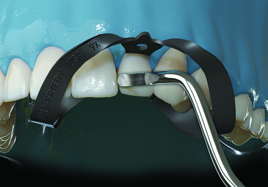  The thin, ductile instrument fits easily into narrow interproximal spaces allow for better visibility as compared to traditional composite instruments.