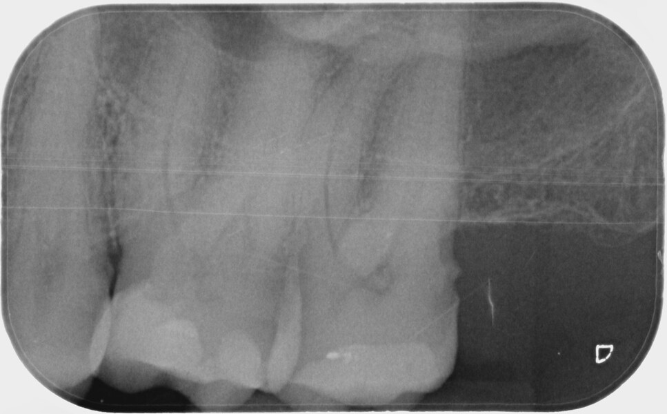 Fig. 3 : Radiographie peropératoire.