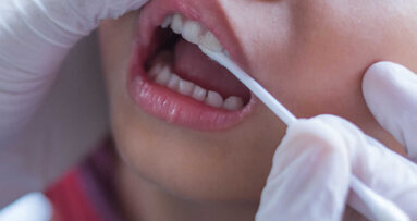 Fluoridni premaz na mlečnih zobeh pozitivno vpliva na preprečevanje kariesa