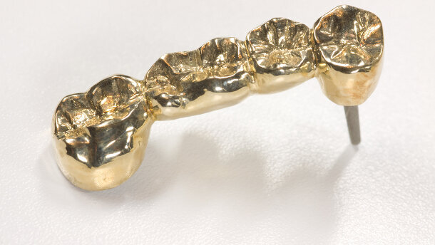 Gold für Dentallegierungen weniger gefragt