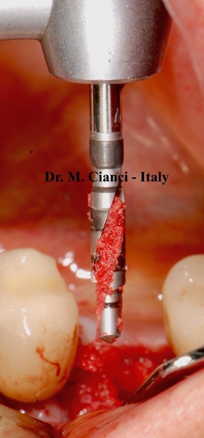 Fig. 7 - Osso granulare autologo recuperato dalla Bio-Fresatura della mandibola. 