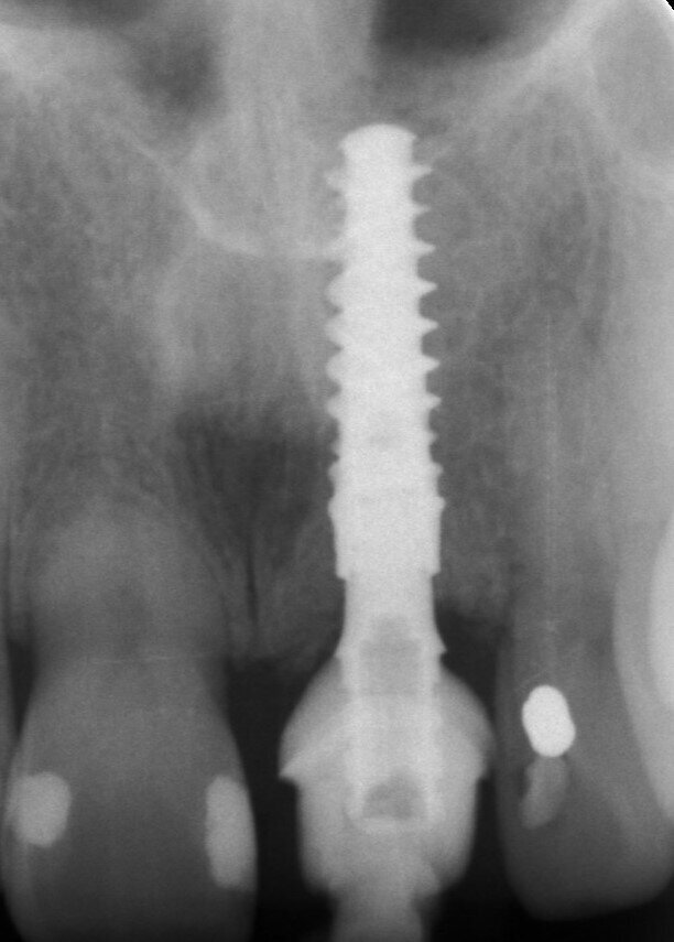 Fig. 29: Periapical radiograph one week post-op.