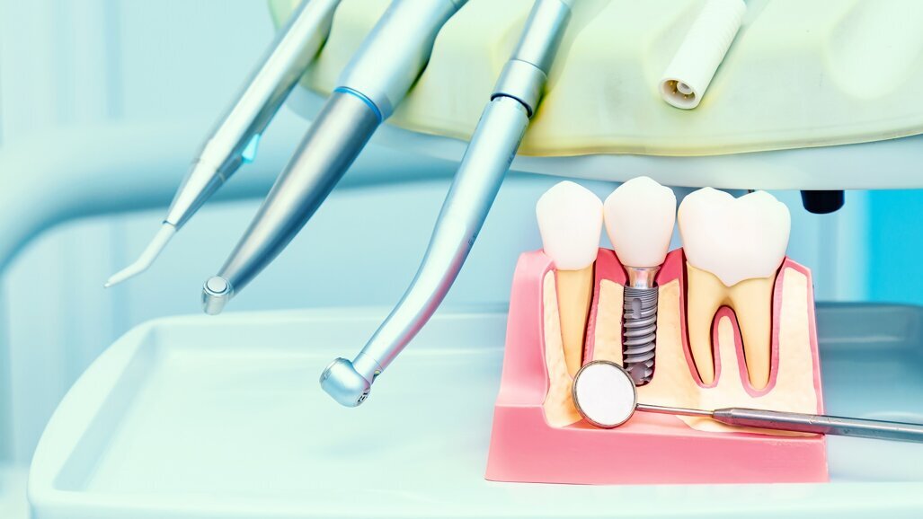 Fare il punto e guardare avanti: il panorama attuale e futuro  degli impianti dentali