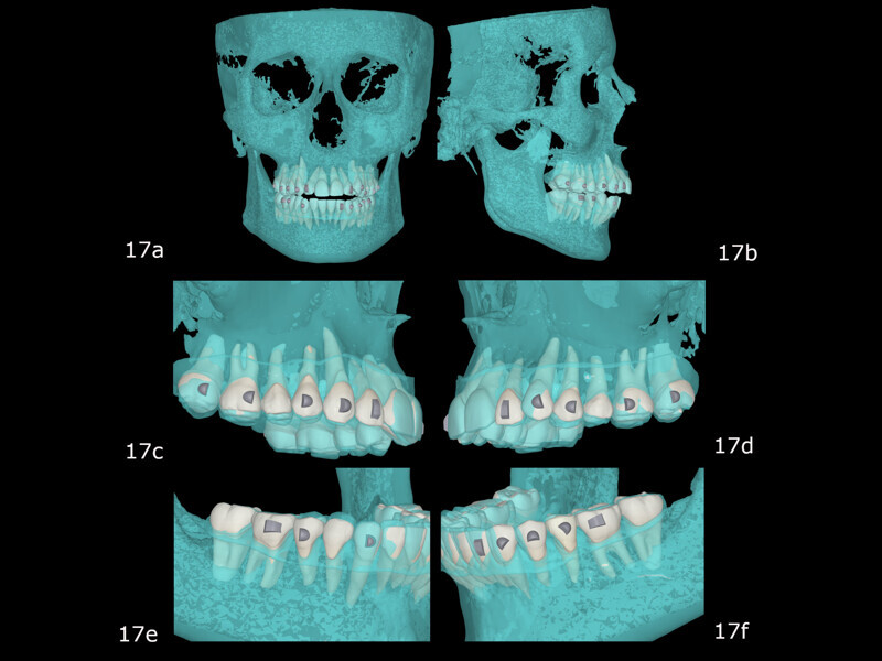 Figs. 17a–f: Visualisation of bone volume in FAS OcclusalDesign. Planned relationship of the teeth post-treatment (white) with the vestibular cortex of the alveolar bone (blue).