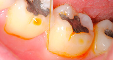 Terapia fotodinamica nelle perimplantiti: un’interessante opportunità?