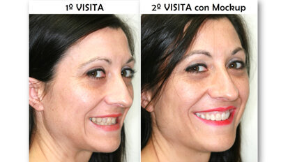 Diseño de sonrisa y neuromarketing