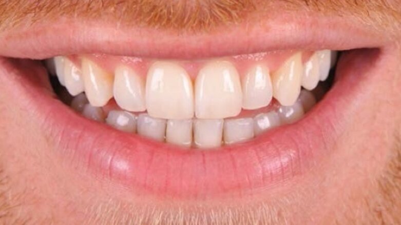 Adhesive cementing of porcelain veneers with PANAVIA V5: A clinical report